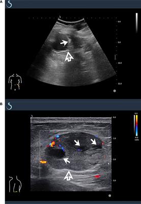 Case report: Ultrasonographic findings of retroperitoneum and abdominal wall metastases of renal cell carcinoma with FH gene deletion